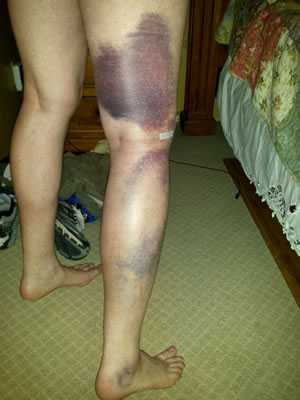 Bruising from knee surgery